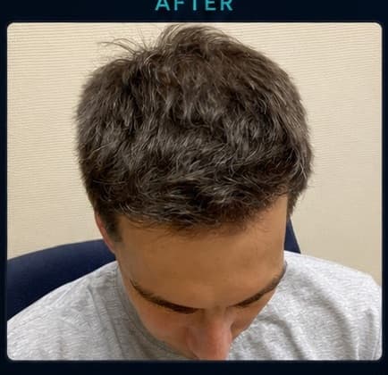 The same patient photographed after growth